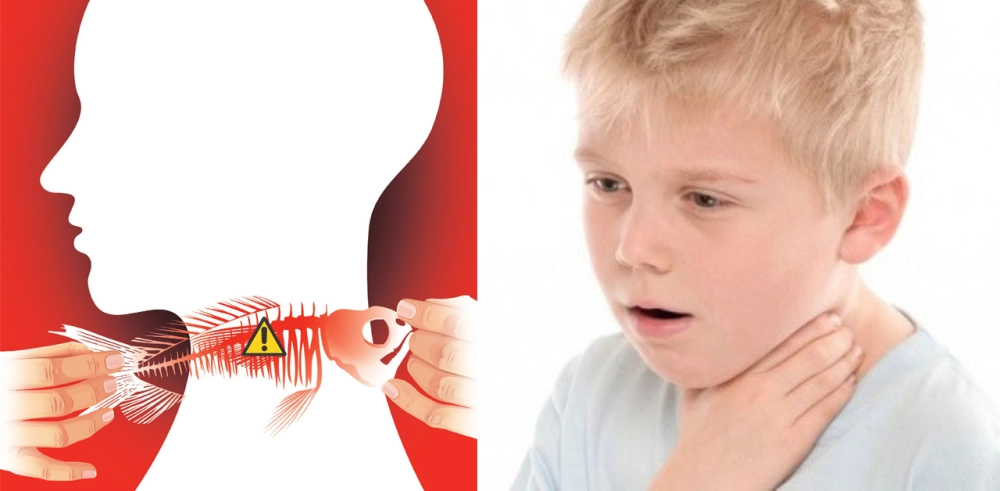 Sự khó chịu khi bị hóc xương cá.