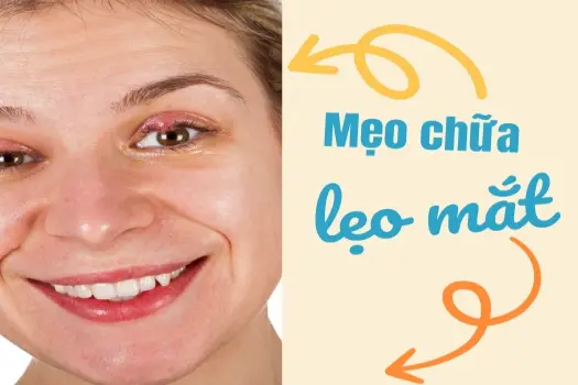 Mẹo chữa lẹo mắt xử lý sưng đỏ, khó chịu dễ dàng tại nhà!