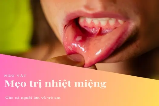 Mẹo chữa nhiệt miệng giảm đau rát, nhanh khỏi ngay tại nhà!